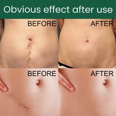 Silicone Gel Scar Patch Roll – Adjustable, Effective Scar Treatment_img_7