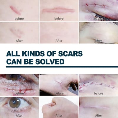 Silicone Gel Scar Patch Roll – Adjustable, Effective Scar Treatment_img_9