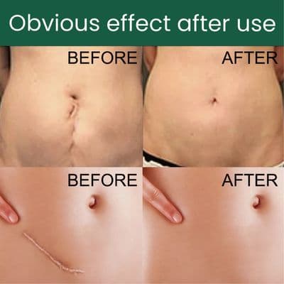 Silicone Gel Scar Patch Roll – Adjustable, Effective Scar Treatment_img_7